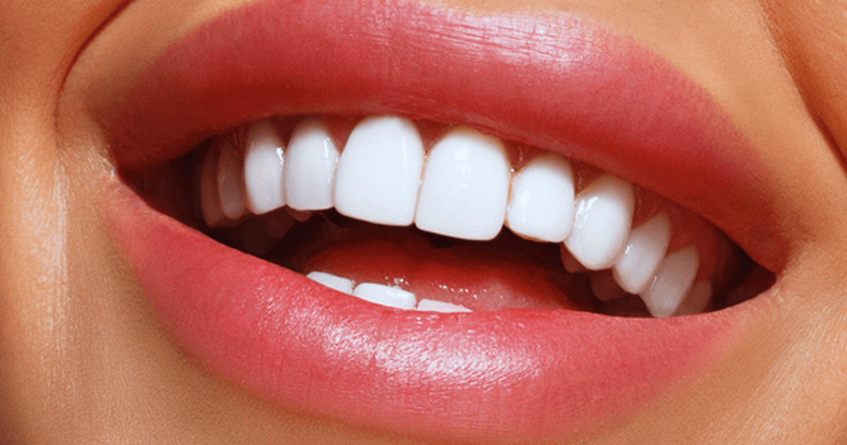 سوالات متداول لمینت دندان، پرسش و پاسخ لمینت دندان